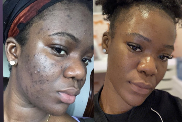 Botox vs Chemical Peels: What’s the Difference?