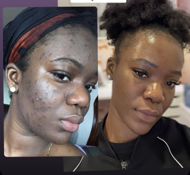 Botox vs Chemical Peels: What’s the Difference?