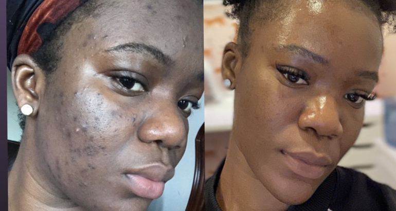 Botox vs Chemical Peels: What’s the Difference?