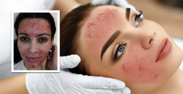 Vampire facial: What is it and why is it so popular?