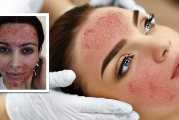 Vampire facial: What is it and why is it so popular?