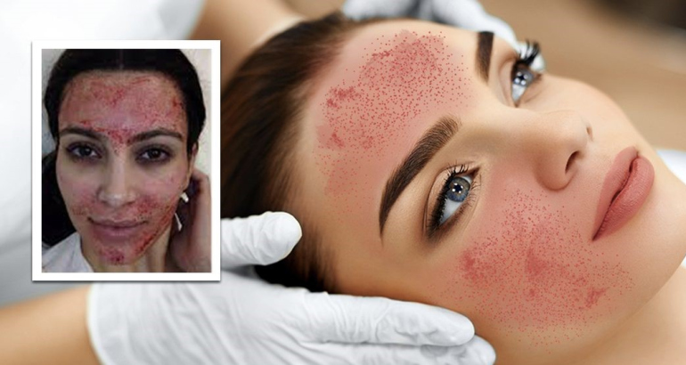 Vampire facial: What is it and why is it so popular?