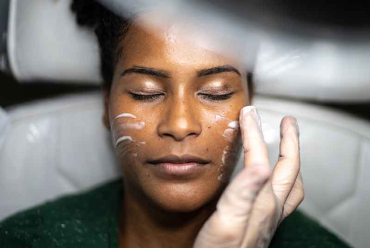 Chemical Peels
