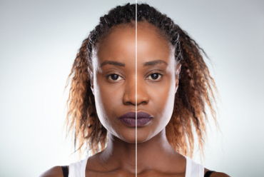 Microderma- Brasion
