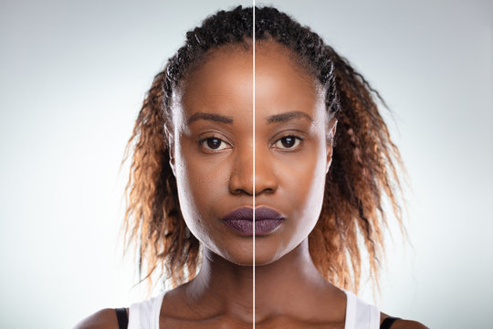 Microderma- Brasion