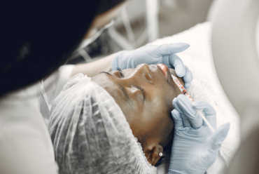 Vampire Facelift